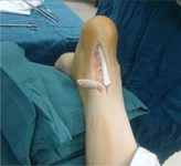 Aşil Tendonu Kopması Belirtileri ve Tedavisi